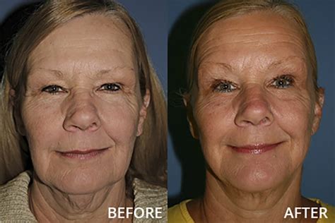 st louis facial cosmetic surgery